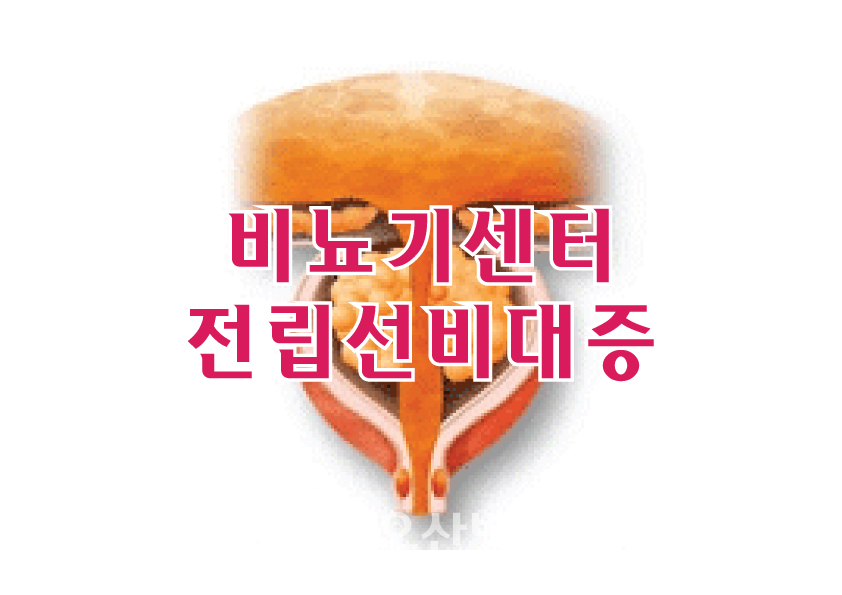 비뇨기센터 - 전립선비대증