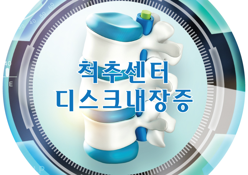 척추센터 - 디스크내장증